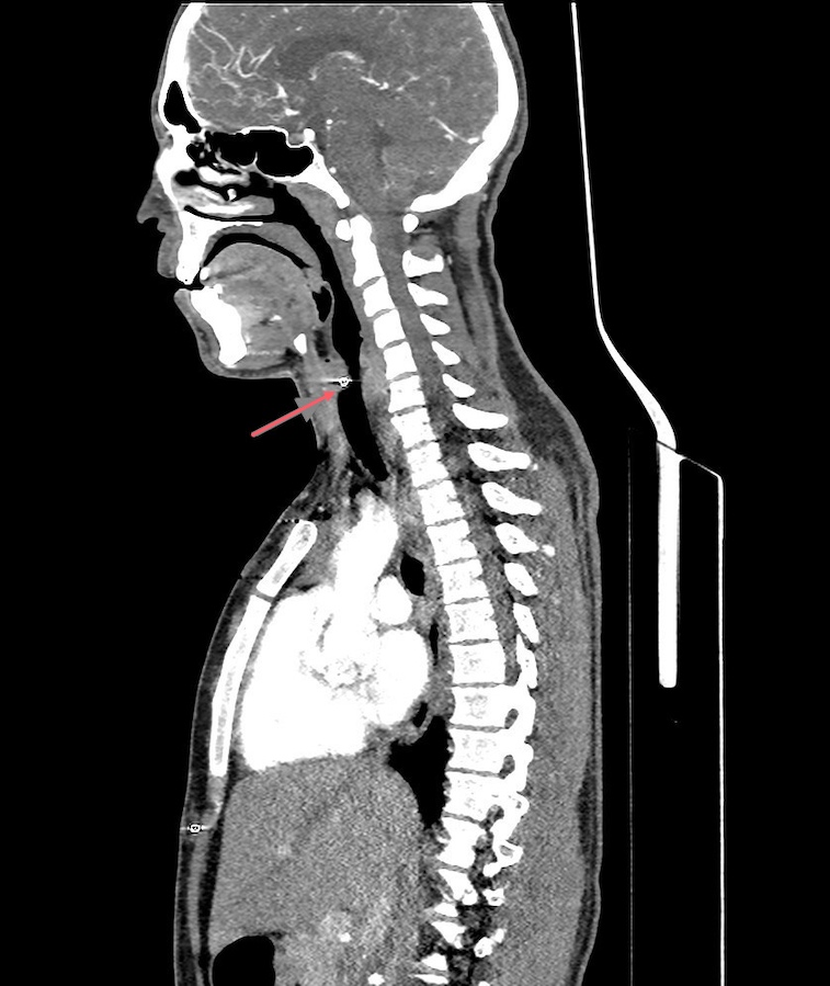 At first glance, the boy is in excruciating pain but there is no major damage. Upon inspection, the pellets seemed to be superficial; however, a CT scan showed that the pellets travelled deep and lodged very close to vital structures including the trachea, lungs, heart, and major arteries.